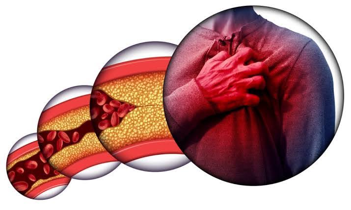 Inovasi Terbaru dalam Mengatasi Dislipidemia, Memahami Ancaman Penyakit Jantung