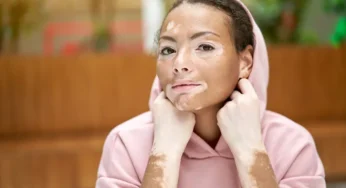 Vitiligo, Penyakit Kulit yang Menyebabkan Kehilangan Pigmen