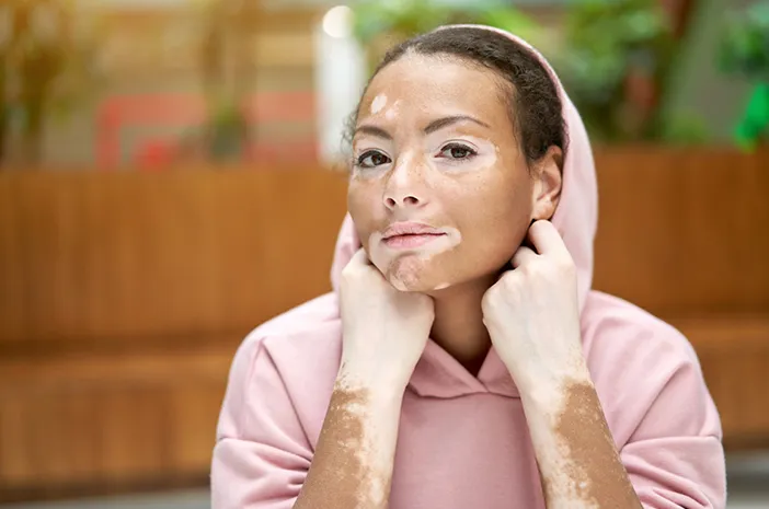 Vitiligo